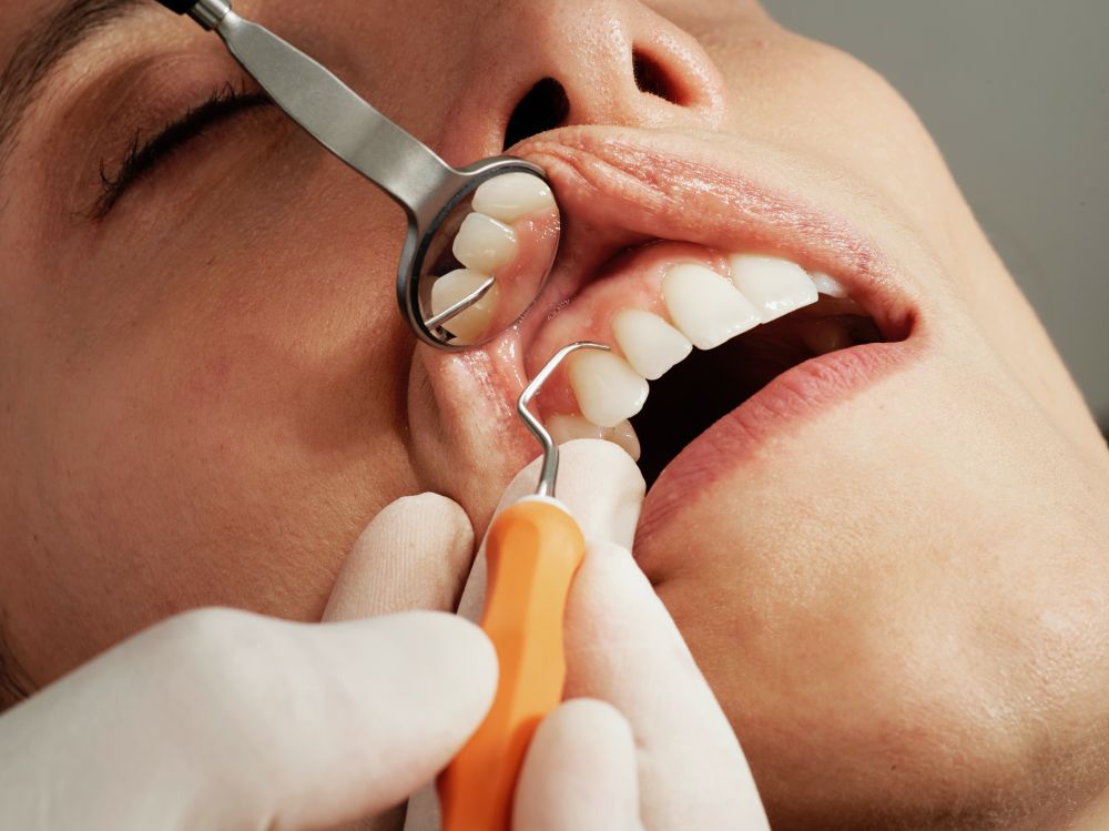 Lad din tandlæge forebygge karies og parodontose